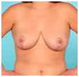 after breast reduction pictures