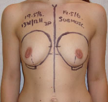 before breast augmentation
